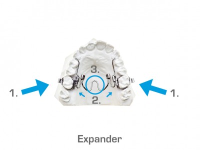 Expander/Rotator/Transforce en TPA (bovenkaak) | 1. Links/rechts heeft de band om de kies losgelaten. U kunt proberen deze terug te drukken, lukt dit niet: het noodnummer bellen. 2. Links of rechts heeft het stangetje losgelaten. U kunt proberen de stang weer in het slot te duwen of de stang aan de andere kant ook los te maken. Hiervoor moet u in de meeste gevallen een elastiekje verwijderen. 3. Het stangetje veroorzaakt een ontsteking in de mondbodem. Hiervoor kunt u het noodnummer bellen.