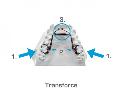 Transforce (Onder- en bovenkaak) | 1. Links/rechts heeft de band om de kies losgelaten. U kunt proberen deze terug te drukken, lukt dit niet: het noodnummer bellen. 2. Links of rechts heeft het stangetje losgelaten. U kunt proberen de stang weer in het slot te duwen of de stang aan de andere kant ook los te maken. Hiervoor moet u in de meeste gevallen een elastiekje verwijderen. 3. Het stangetje veroorzaakt een ontsteking in de mondbodem. Hiervoor kunt u het noodnummer bellen.